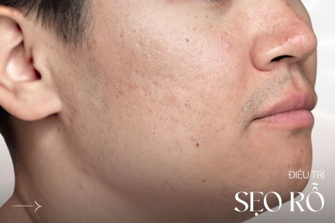 Điều trị sẹo rỗ